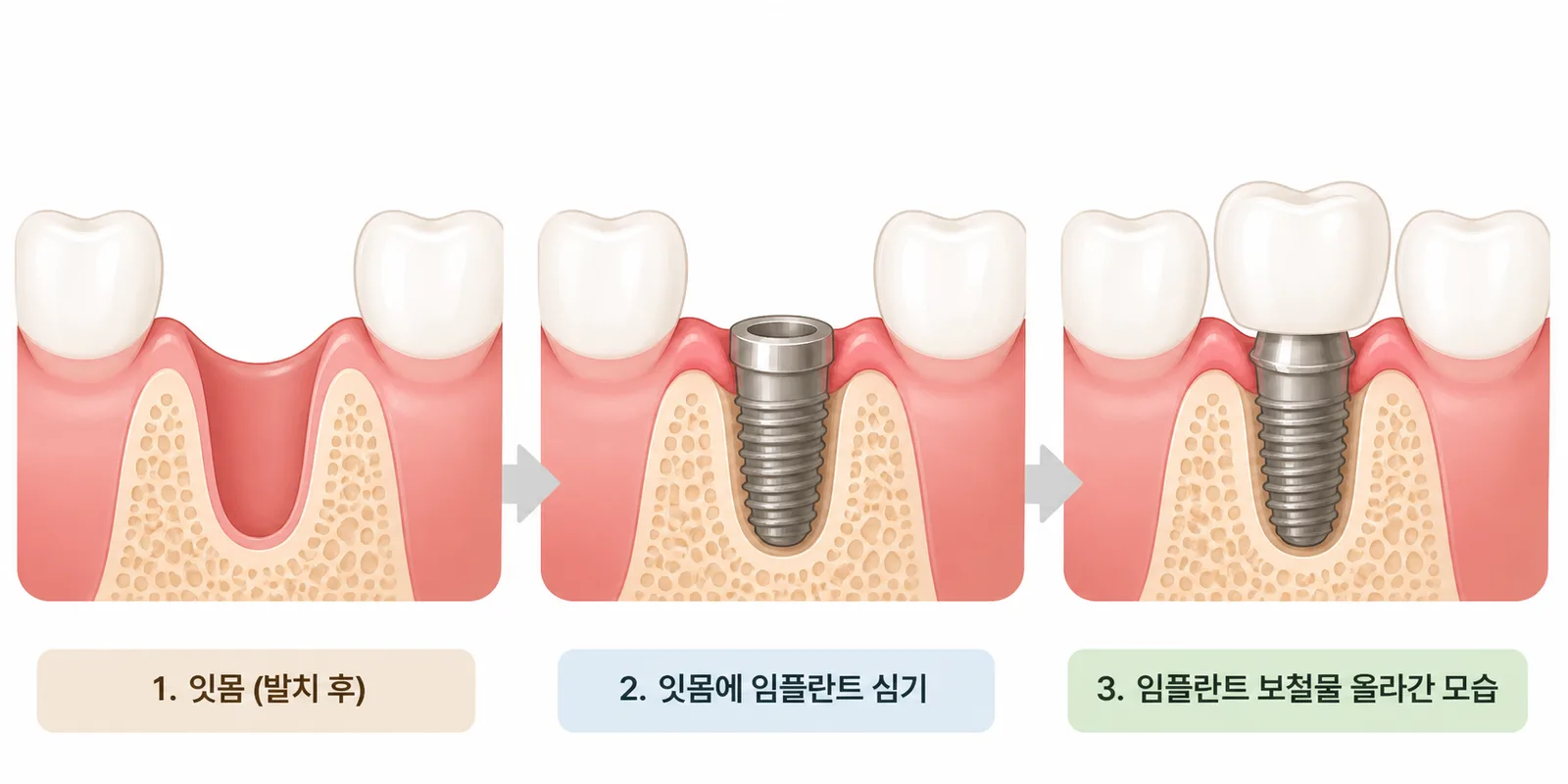 명지동 임플란트 — 발치부터 완성까지 과정·기간·비용 총정리