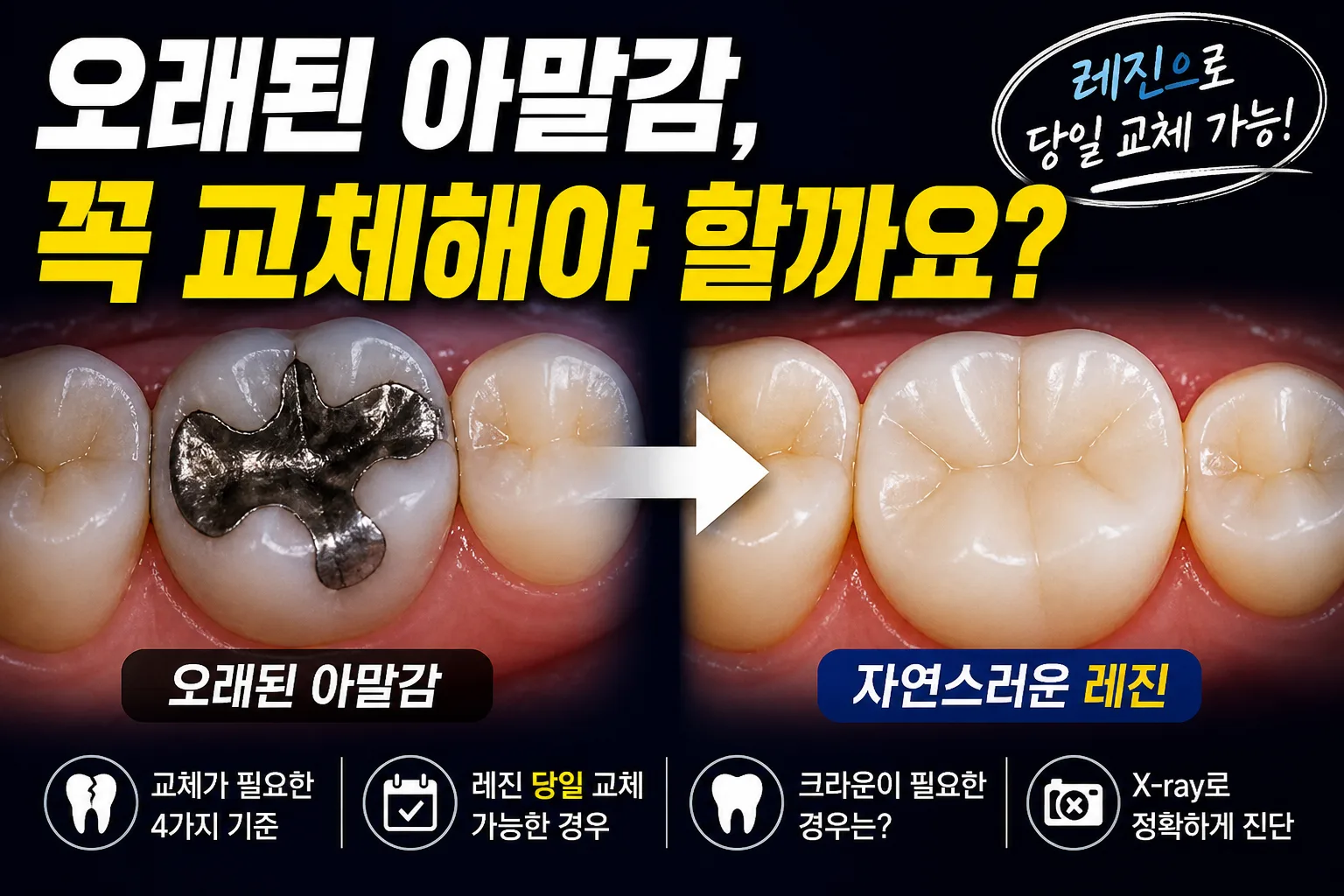 명지동 치과 | 오래된 아말감 꼭 교체해야 할까요? 레진으로 당일 교체하는 법 (2026)